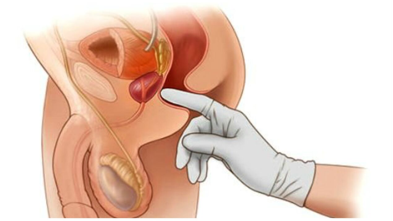 Prostatos masažas sergant lėtiniu prostatitu