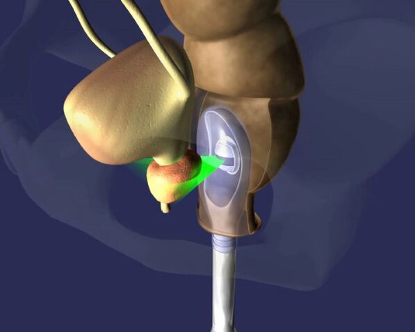 ultragarso poveikis prostatai sergant prostatitu