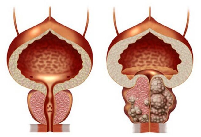 sveika prostata ir prostatos adenoma