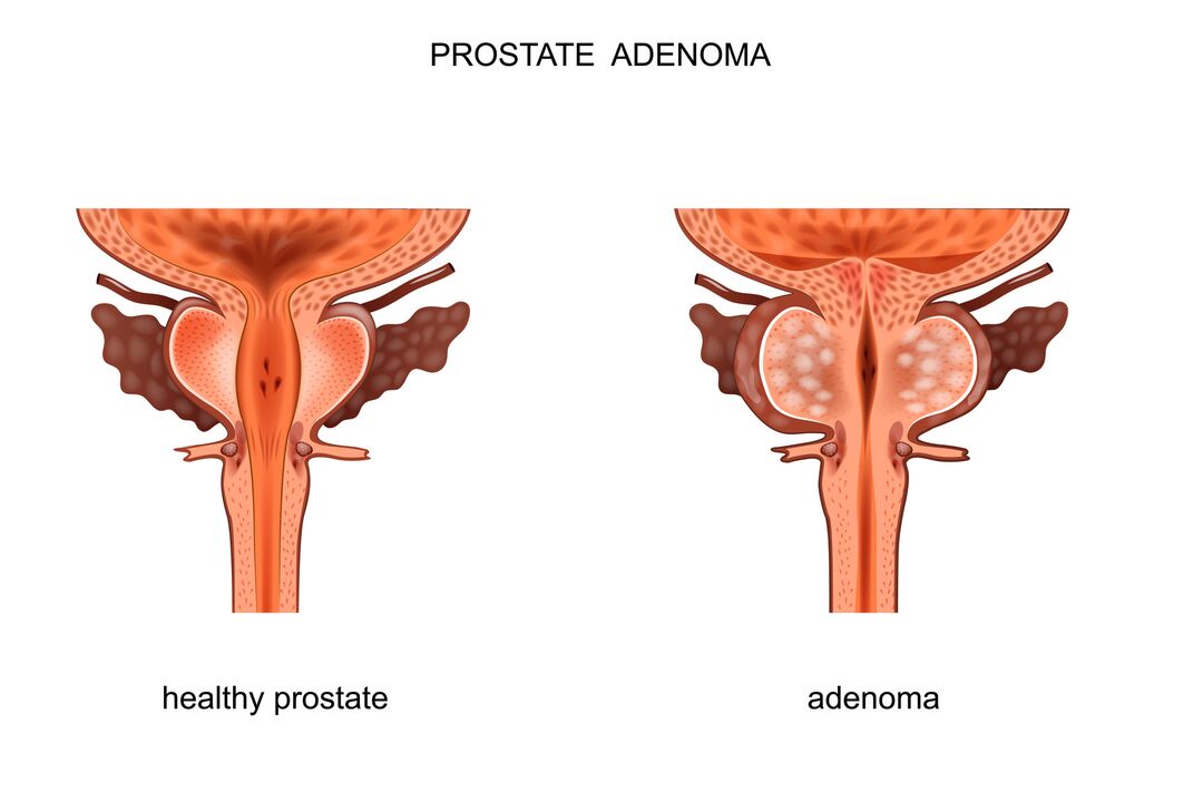 sveika prostata ir su adenoma